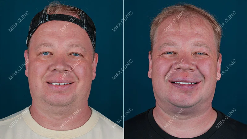 From Dental Planning to the New Hollywood Smile
